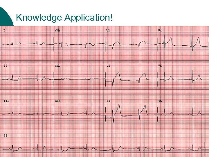 Knowledge Application! ¡ ¡ ¡ Is there any ST segment deviation? What leads are