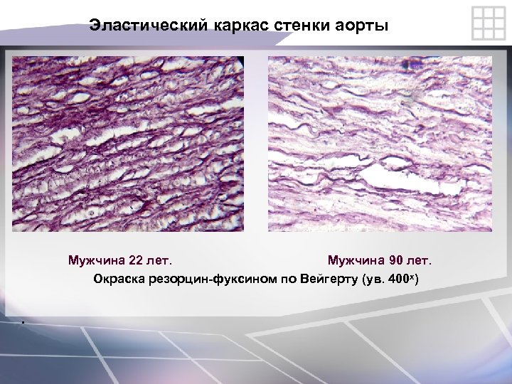 Эластический каркас стенки аорты Мужчина 22 лет. Мужчина 90 лет. Окраска резорцин-фуксином по Вейгерту