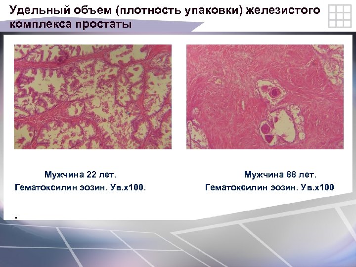 Удельный объем (плотность упаковки) железистого комплекса простаты Мужчина 22 лет. Мужчина 88 лет. Гематоксилин