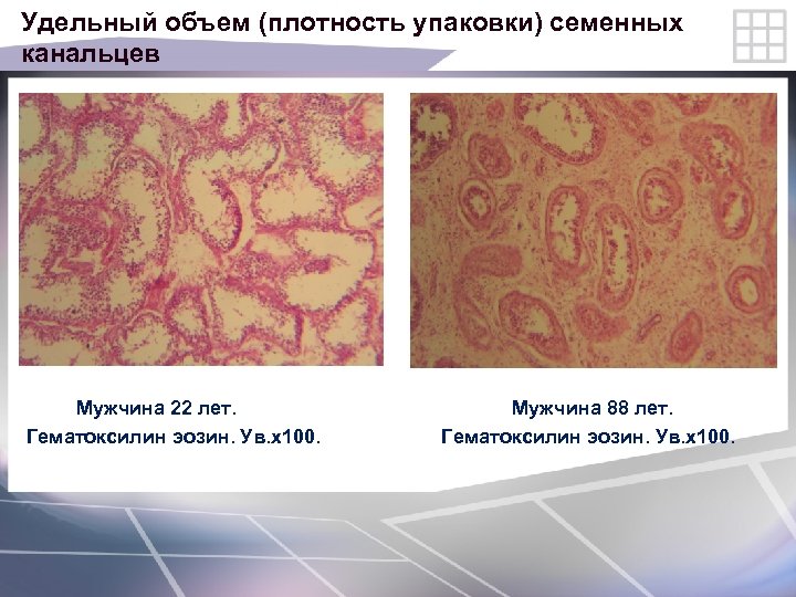 Удельный объем (плотность упаковки) семенных канальцев Мужчина 22 лет. Мужчина 88 лет. Гематоксилин эозин.