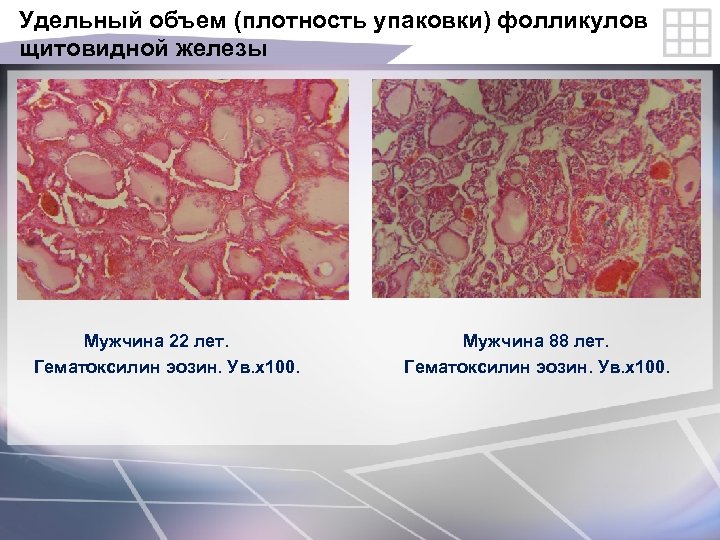 Удельный объем (плотность упаковки) фолликулов щитовидной железы Мужчина 22 лет. Мужчина 88 лет. Гематоксилин