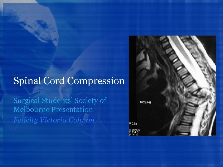 Spinal Cord Compression Surgical Students’ Society of Melbourne Presentation Felicity Victoria Connon 