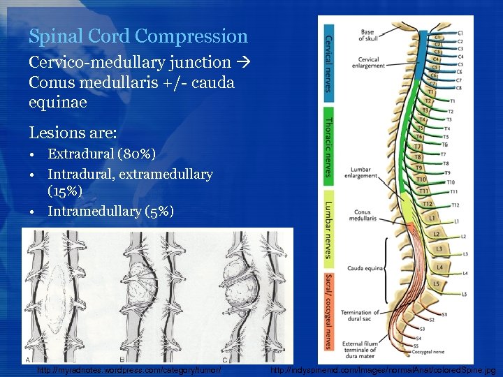 Spinal Cord Compression Cervico-medullary junction Conus medullaris +/- cauda equinae Lesions are: • Extradural