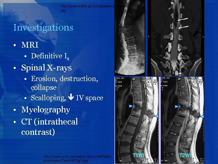 http: //www. ortho. pe. kr/upload/ank_spond 02. jpg Investigations • MRI • Definitive Ix •