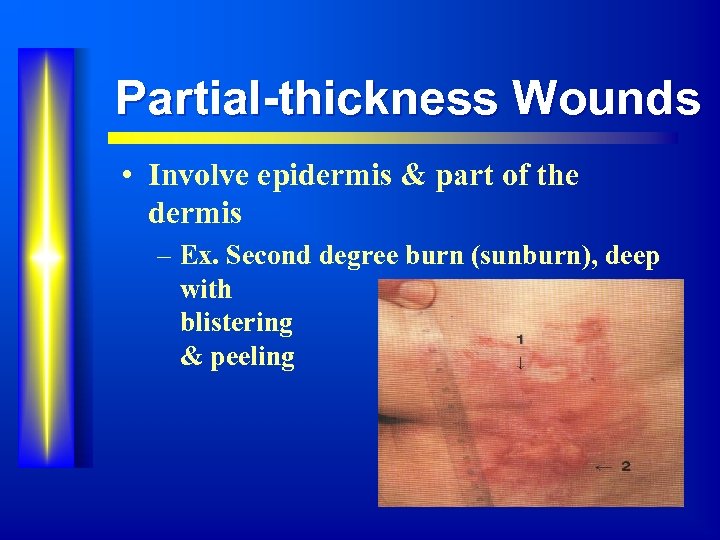 Partial-thickness Wounds • Involve epidermis & part of the dermis – Ex. Second degree