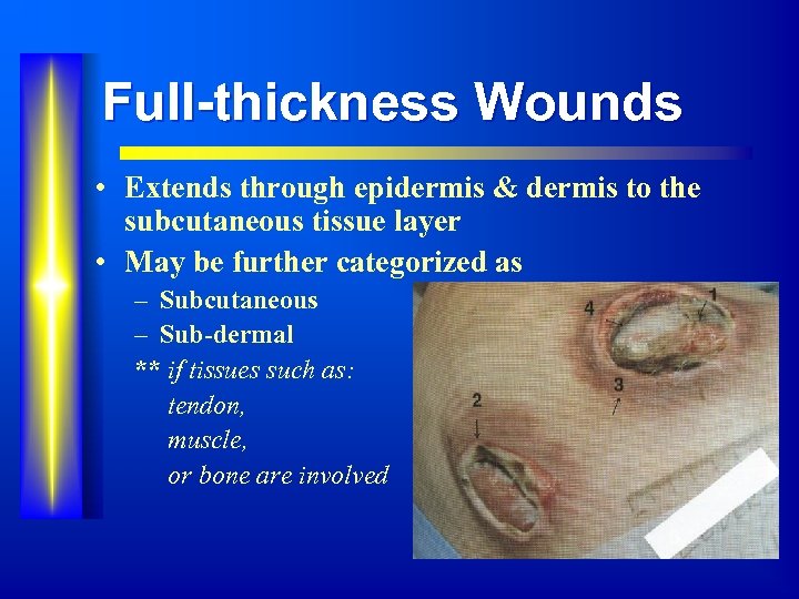 Full-thickness Wounds • Extends through epidermis & dermis to the subcutaneous tissue layer •