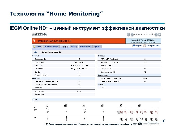 Технология “Home Monitoring” IEGM Online HD® – ценный инструмент эффективной диагностики XIV Международная конференция