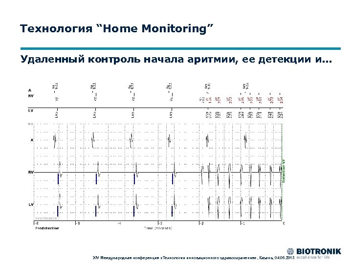 Технология “Home Monitoring” Удаленный контроль начала аритмии, ее детекции и. . . XIV Международная