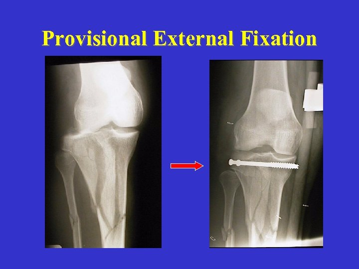 Provisional External Fixation 