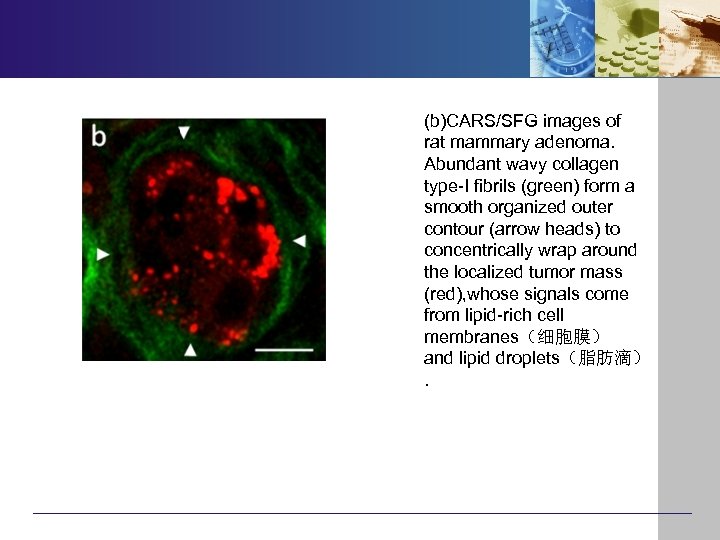 (b)CARS/SFG images of rat mammary adenoma. Abundant wavy collagen type-I fibrils (green) form a