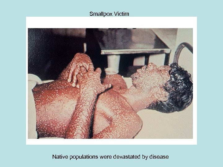 Smallpox Victim Native populations were devastated by disease 