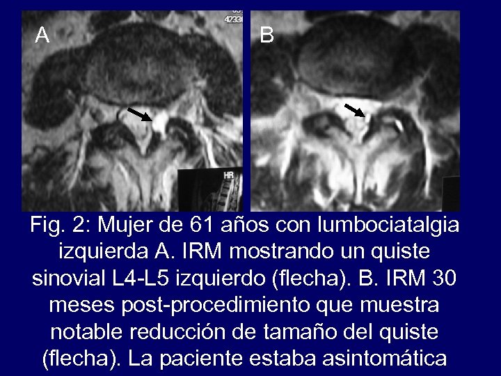 A B Fig. 2: Mujer de 61 años con lumbociatalgia izquierda A. IRM mostrando