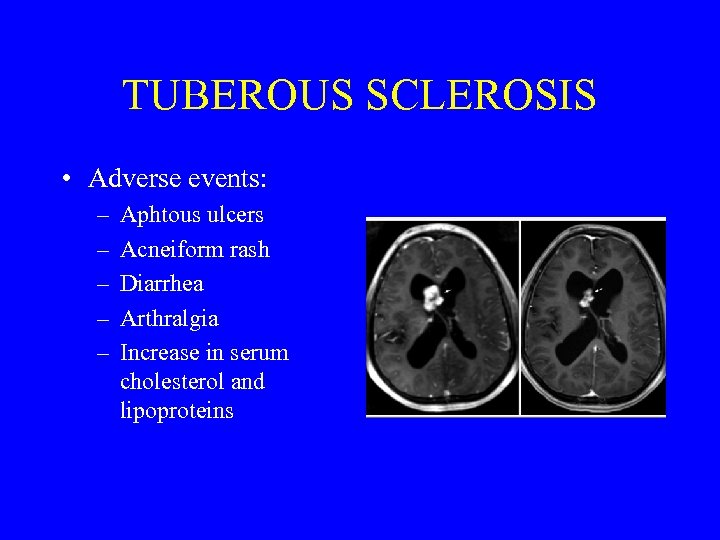 TUBEROUS SCLEROSIS • Adverse events: – – – Aphtous ulcers Acneiform rash Diarrhea Arthralgia