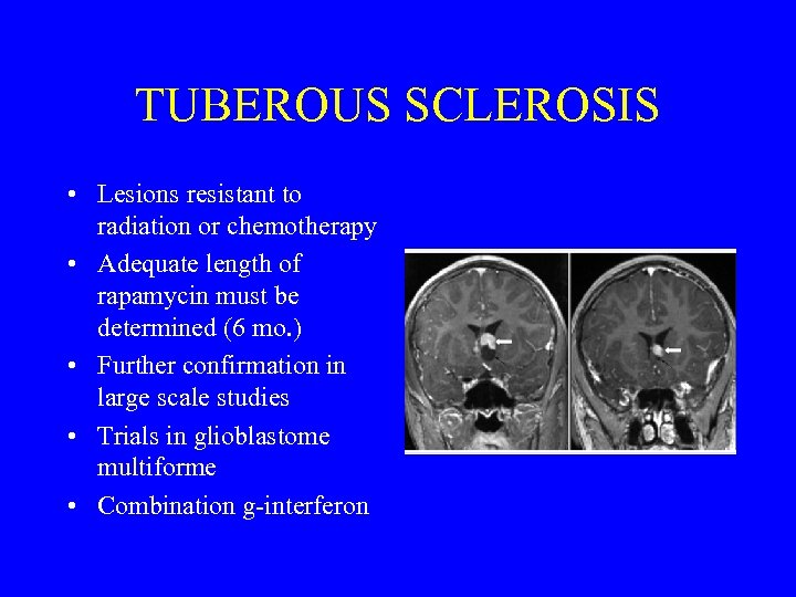 TUBEROUS SCLEROSIS • Lesions resistant to radiation or chemotherapy • Adequate length of rapamycin