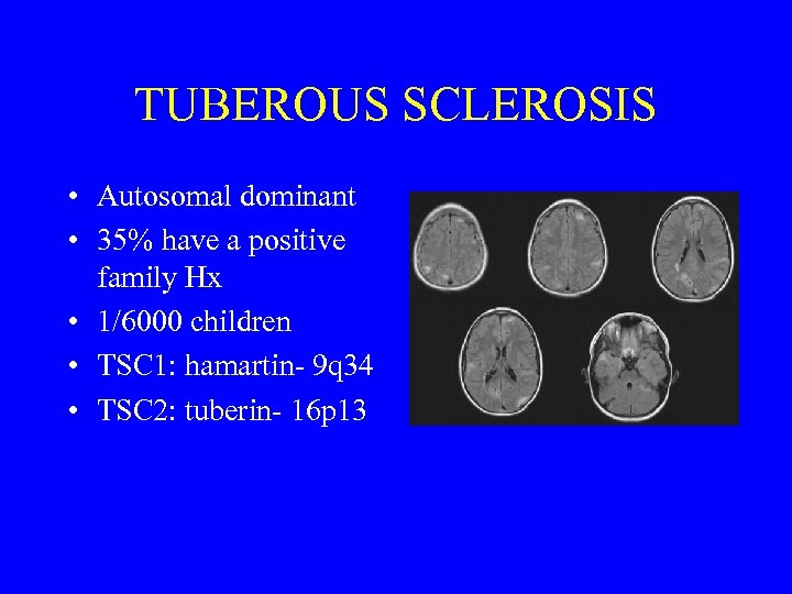 TUBEROUS SCLEROSIS • Autosomal dominant • 35% have a positive family Hx • 1/6000