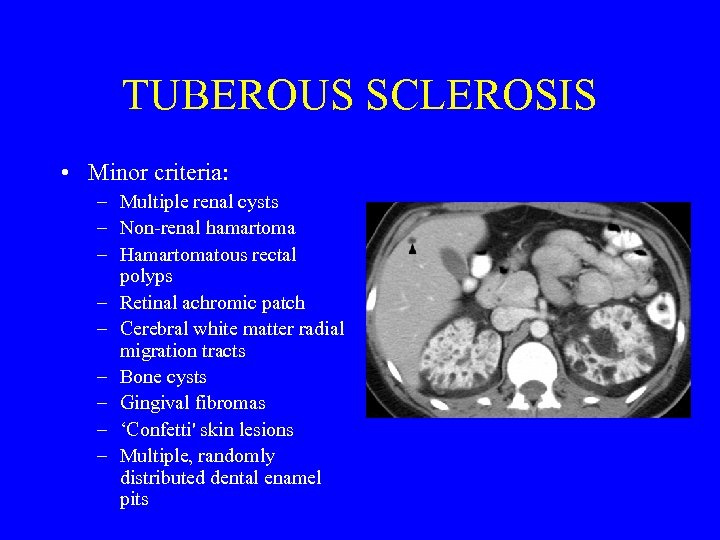 TUBEROUS SCLEROSIS • Minor criteria: – Multiple renal cysts – Non-renal hamartoma – Hamartomatous