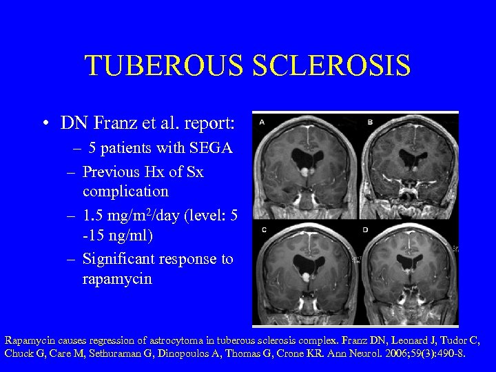 TUBEROUS SCLEROSIS • DN Franz et al. report: – 5 patients with SEGA –