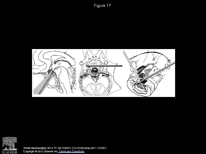 Figure 17 World Neurosurgery 2012 77, 92 -102 DOI: (10. 1016/j. wneu. 2011. 10.