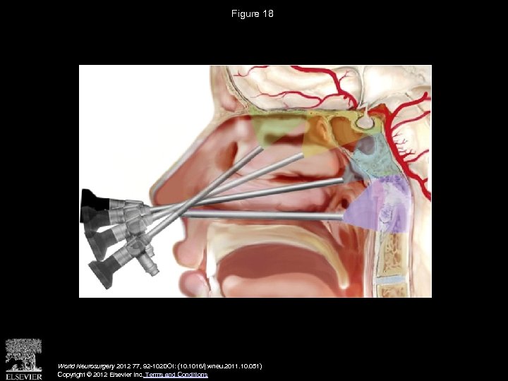Figure 18 World Neurosurgery 2012 77, 92 -102 DOI: (10. 1016/j. wneu. 2011. 10.