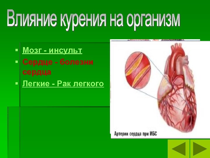 § Мозг - инсульт § Сердце - болезни сердца § Легкие - Рак легкого