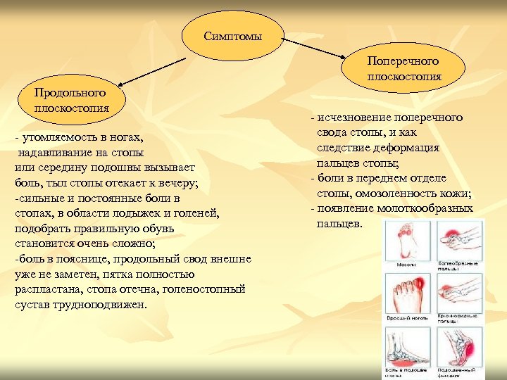 Симптомы Поперечного плоскостопия Продольного плоскостопия - утомляемость в ногах, надавливание на стопы или середину