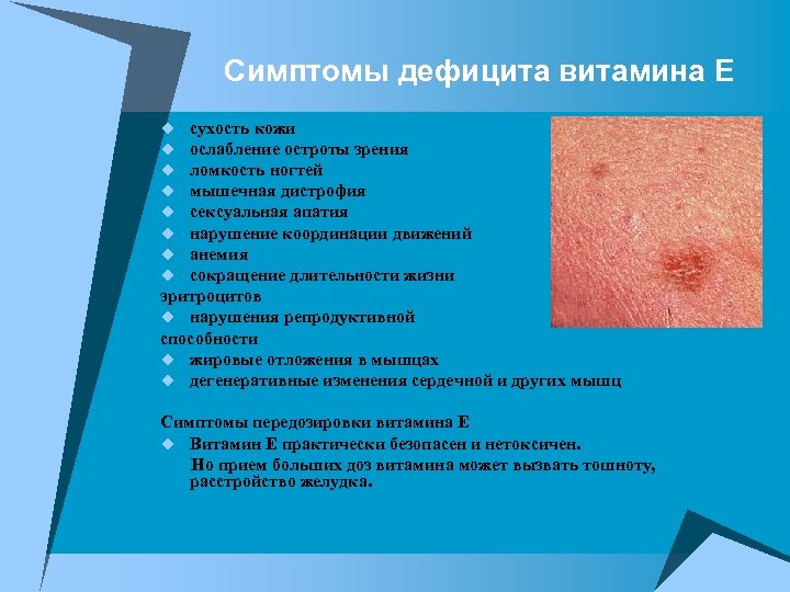 Симптомы дефицита витамина Е сухость кожи ослабление остроты зрения ломкость ногтей мышечная дистрофия сексуальная