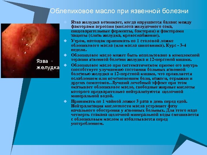 Облепиховое масло при язвенной болезни u Язва желудка возникает, когда нарушается баланс между u