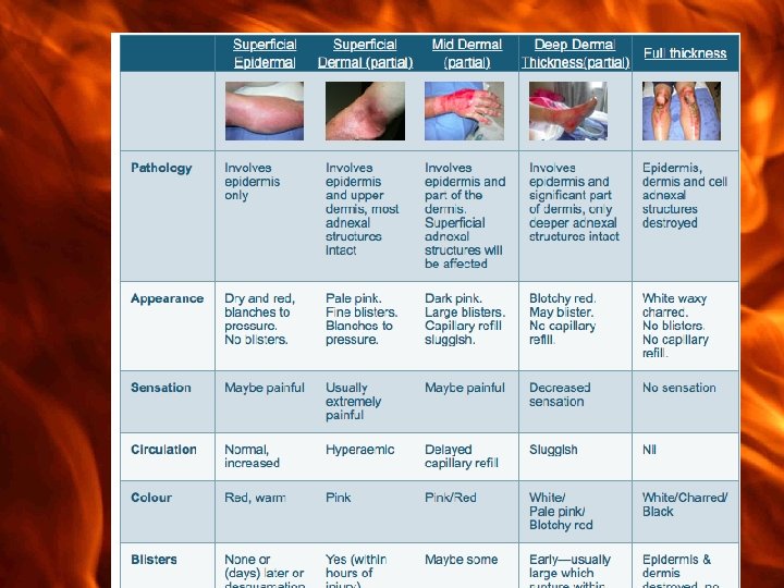 first degree burn treatment guidelines
