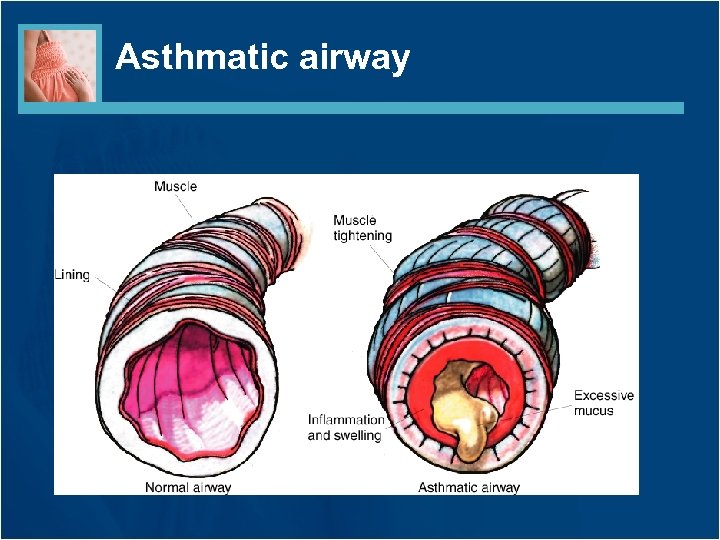 Asthmatic airway 