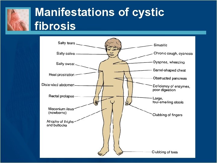 Manifestations of cystic fibrosis 