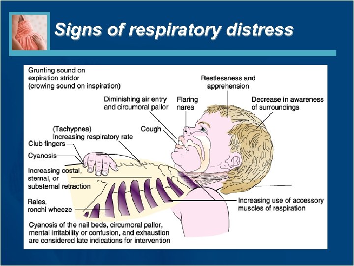 Signs of respiratory distress 