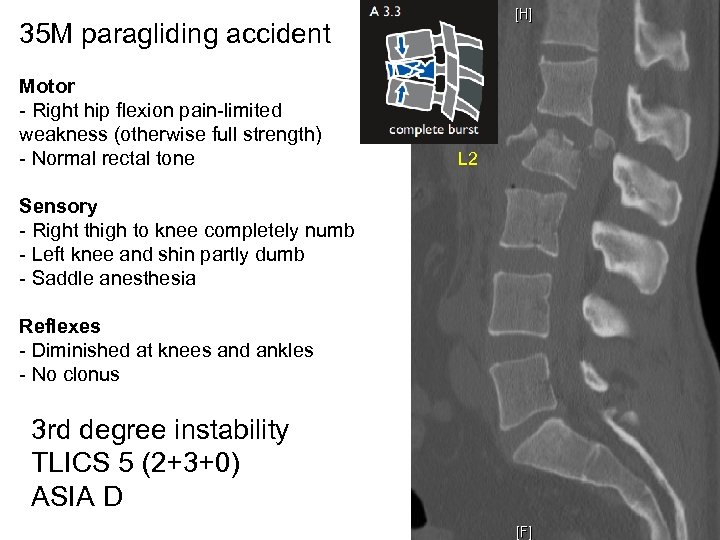 35 M paragliding accident Motor - Right hip flexion pain-limited weakness (otherwise full strength)