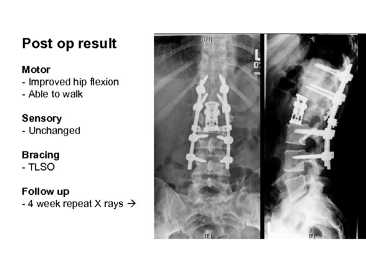 Post op result Motor - Improved hip flexion - Able to walk Sensory -