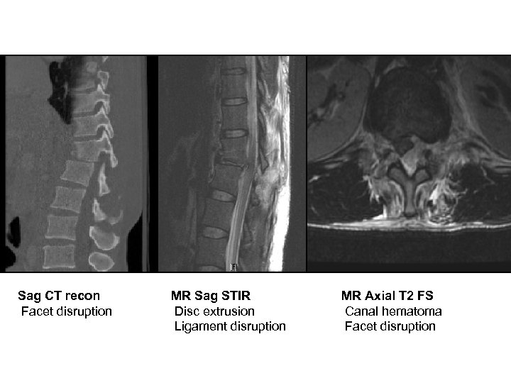 Sag CT recon Facet disruption MR Sag STIR Disc extrusion Ligament disruption MR Axial