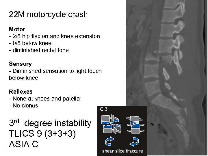 22 M motorcycle crash Motor - 2/5 hip flexion and knee extension - 0/5