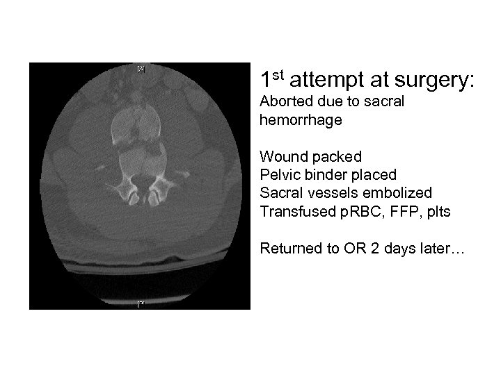 1 st attempt at surgery: Aborted due to sacral hemorrhage Wound packed Pelvic binder