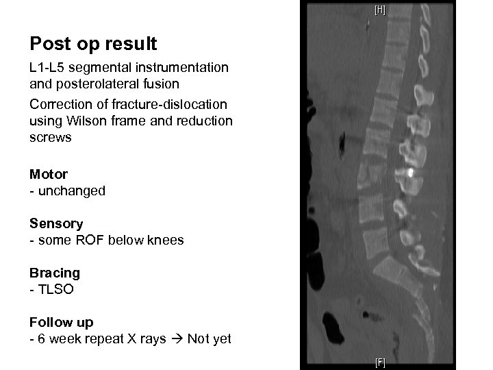 Post op result L 1 -L 5 segmental instrumentation and posterolateral fusion Correction of