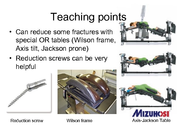 Teaching points • Can reduce some fractures with special OR tables (Wilson frame, Axis