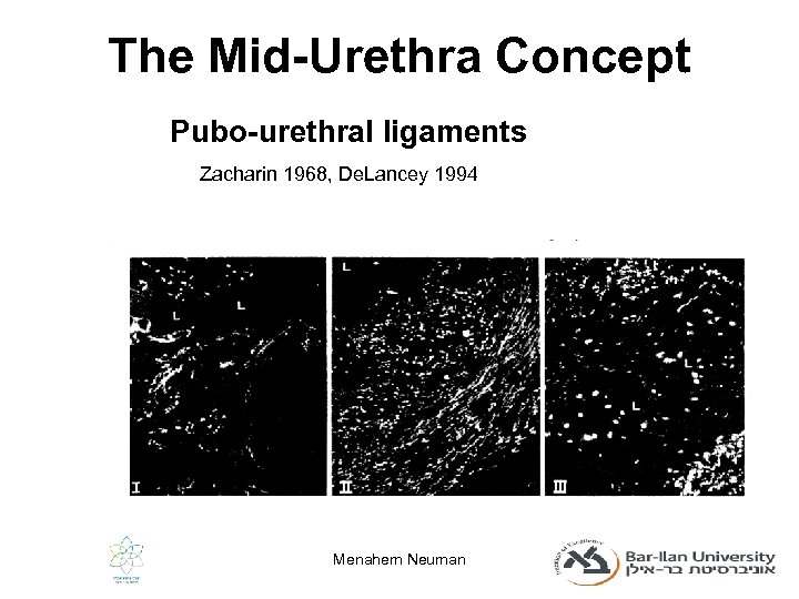 The Mid-Urethra Concept Pubo-urethral ligaments Zacharin 1968, De. Lancey 1994 Menahem Neuman 