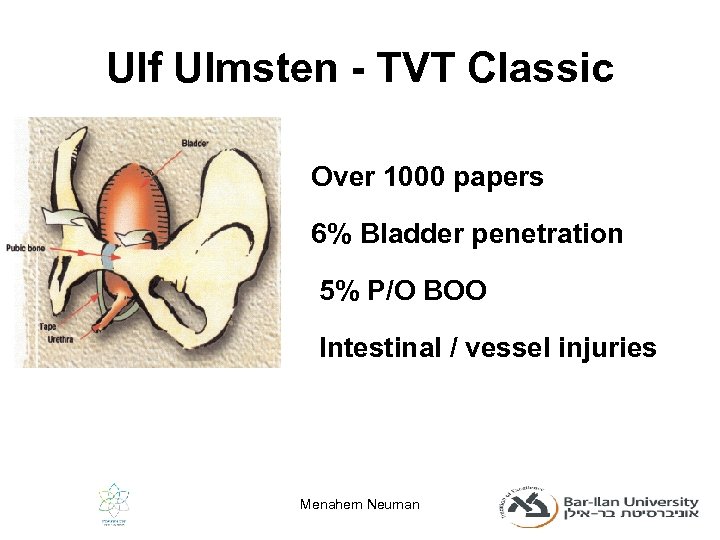 Ulf Ulmsten - TVT Classic Over 1000 papers 6% Bladder penetration 5% P/O BOO