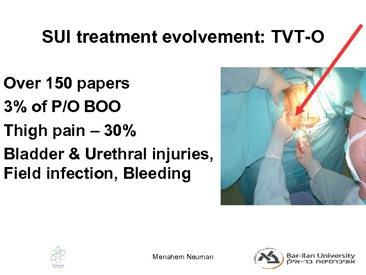 SUI treatment evolvement: TVT-O Over 150 papers 3% of P/O BOO Thigh pain –