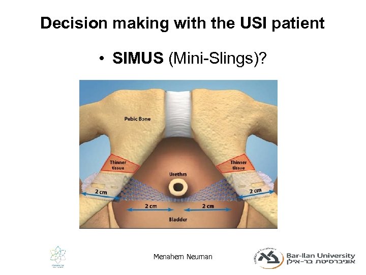 Decision making with the USI patient • SIMUS (Mini-Slings)? Menahem Neuman 