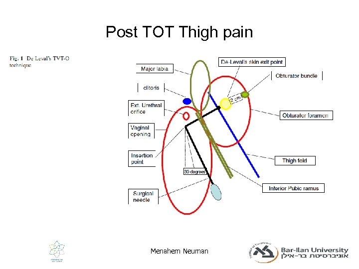 Post TOT Thigh pain Menahem Neuman 