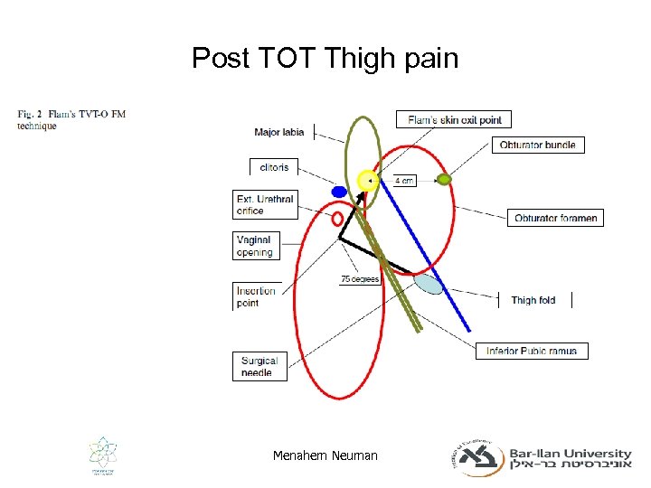 Post TOT Thigh pain Menahem Neuman 