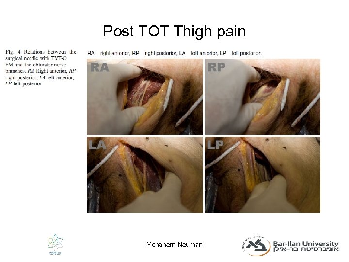 Post TOT Thigh pain Menahem Neuman 