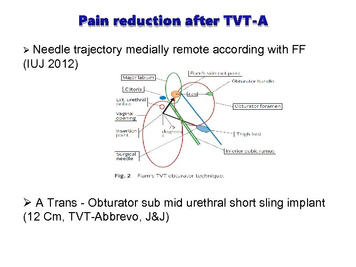 Pain reduction after TVT-A Ø Needle trajectory medially remote according with FF (IUJ 2012)