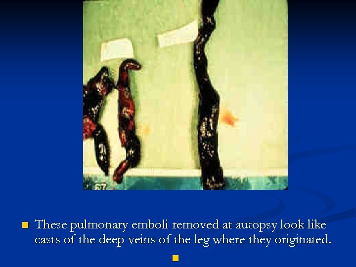 n These pulmonary emboli removed at autopsy look like casts of the deep veins