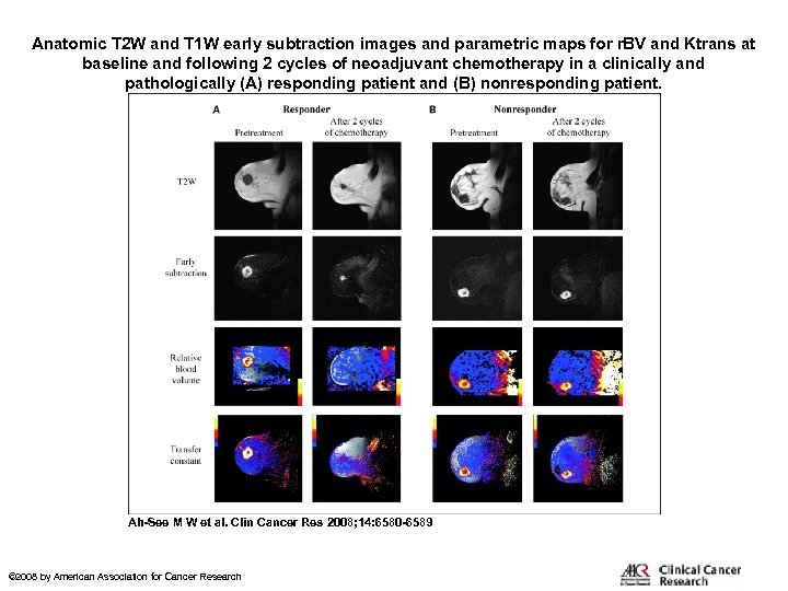 Anatomic T 2 W and T 1 W early subtraction images and parametric maps