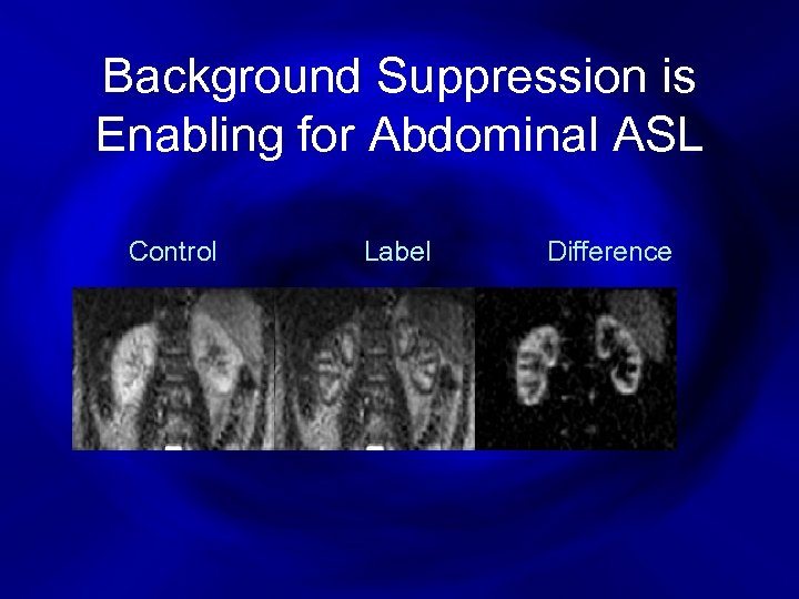 Background Suppression is Enabling for Abdominal ASL Control Label Difference 