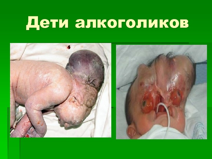 Дети алкоголиков 